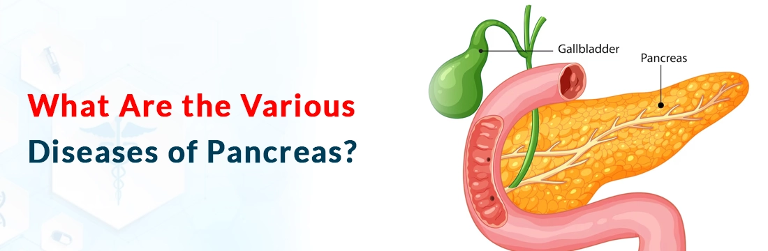  What Are the Various Diseases of Pancreas?